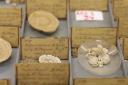 The unique collection of bladder stones kept at the Norfolk and Norwich University Hospital (Picture: Archant)